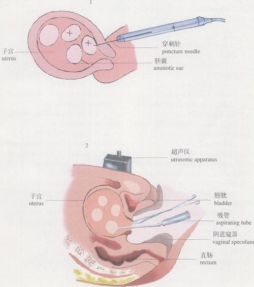  减胎手术