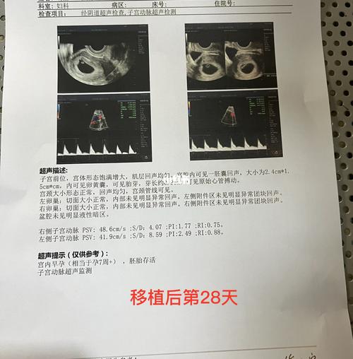 移植后 28 天