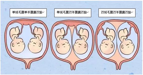  多胎妊娠