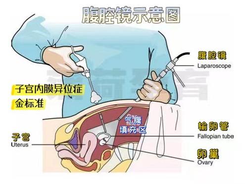 腹腔镜检查