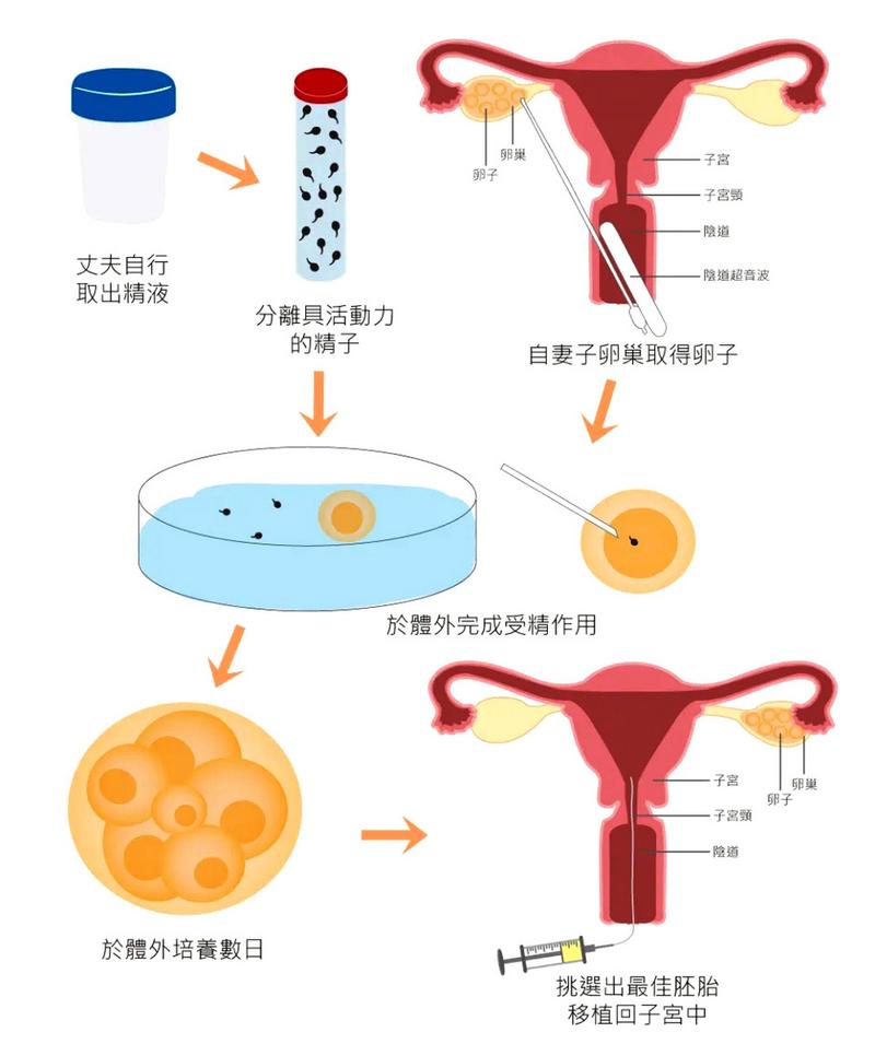 传统试管婴儿技术