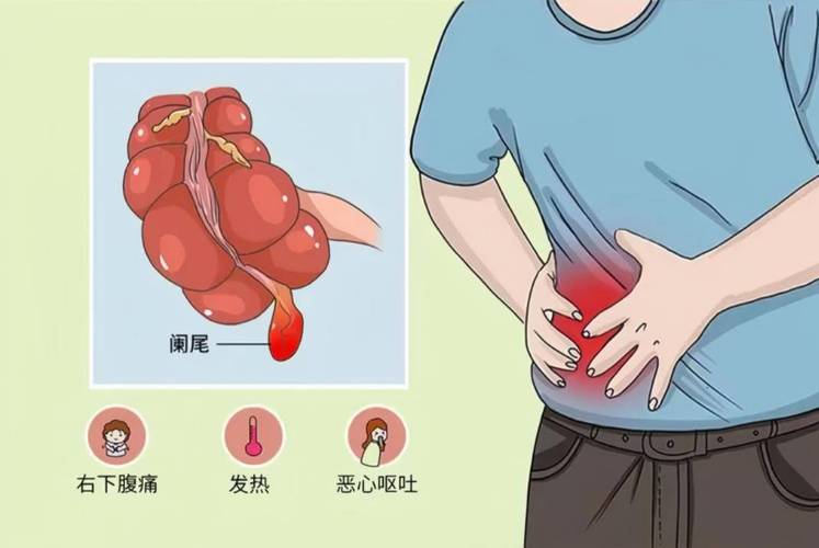 阑尾炎