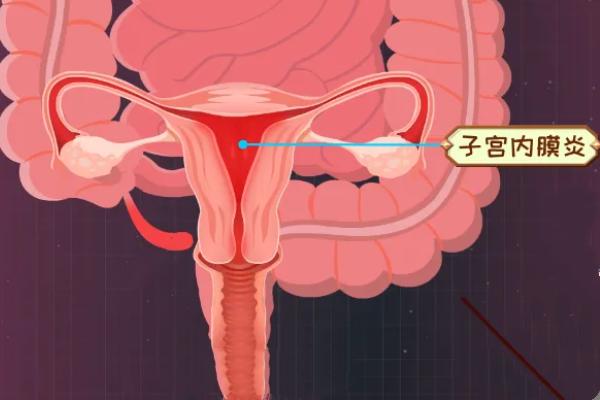 试管婴儿、内膜炎症、生殖医学