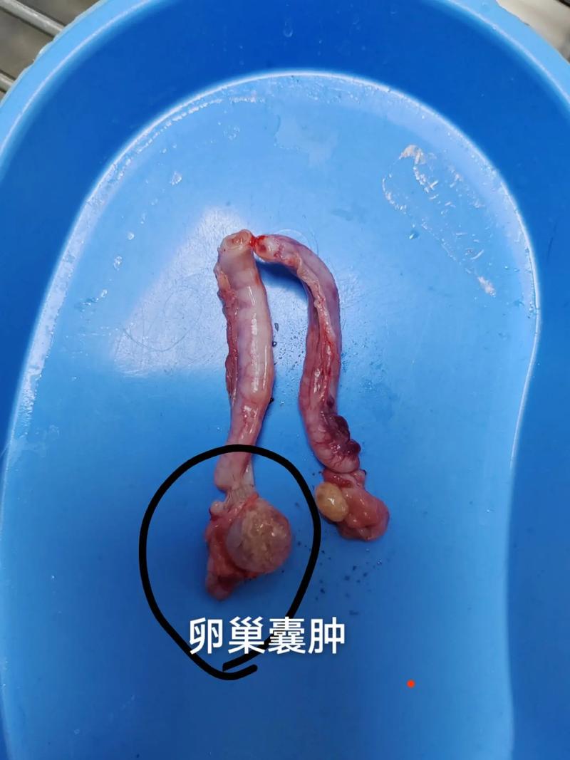 卵巢囊肿