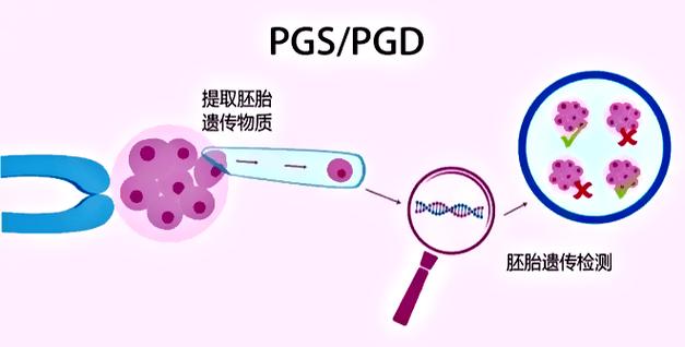 二代试管婴儿：如何降低先天缺陷风险？