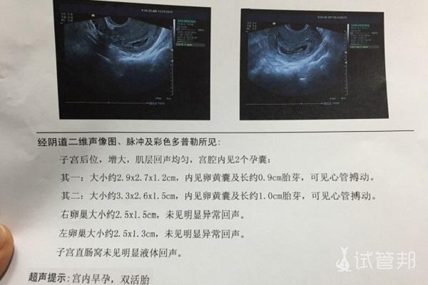试管婴儿、单囊双胎、移植成功率、孕期检查