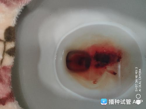 试管流产