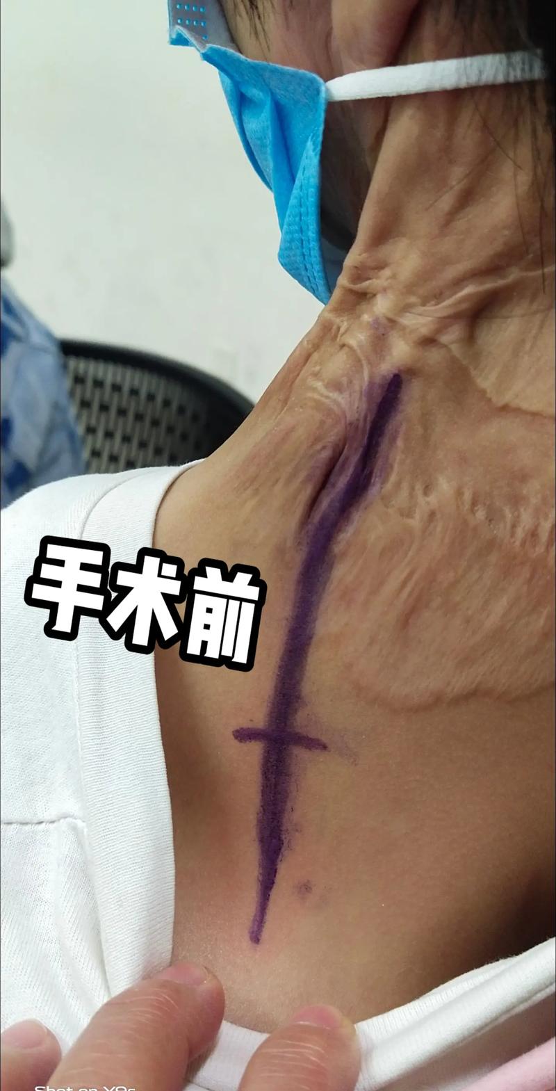 手术