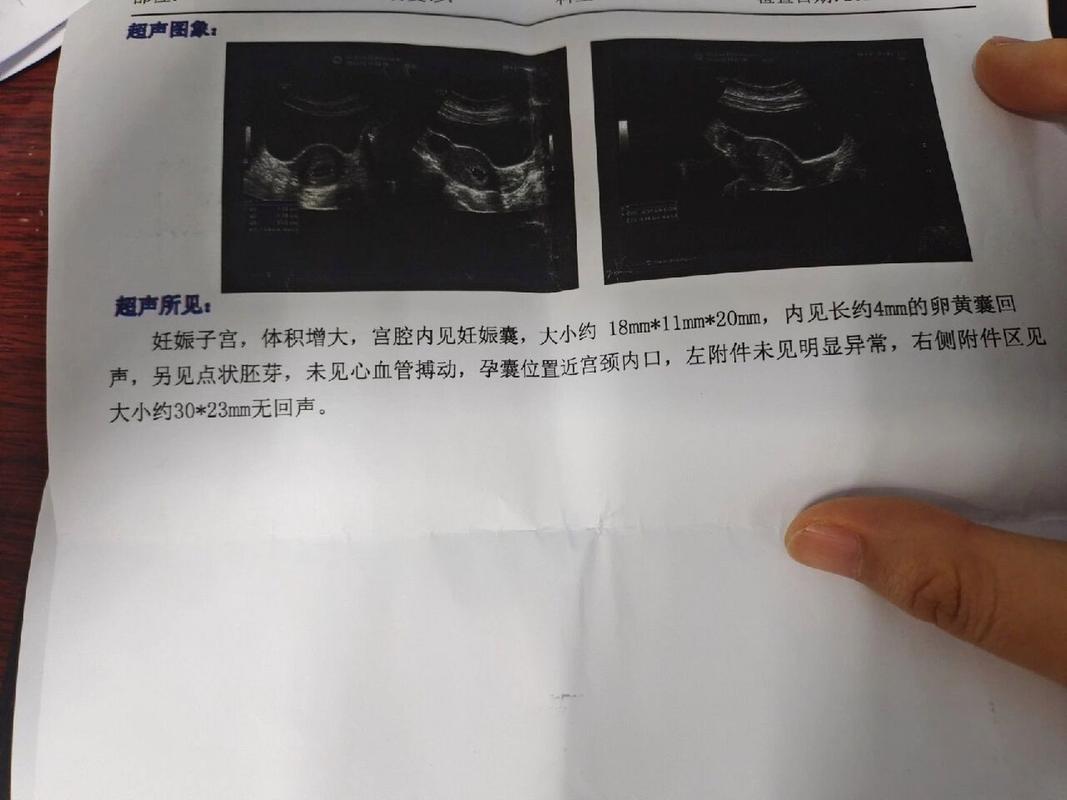 孕囊位置偏低