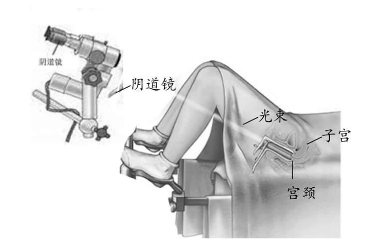 阴道镜检查