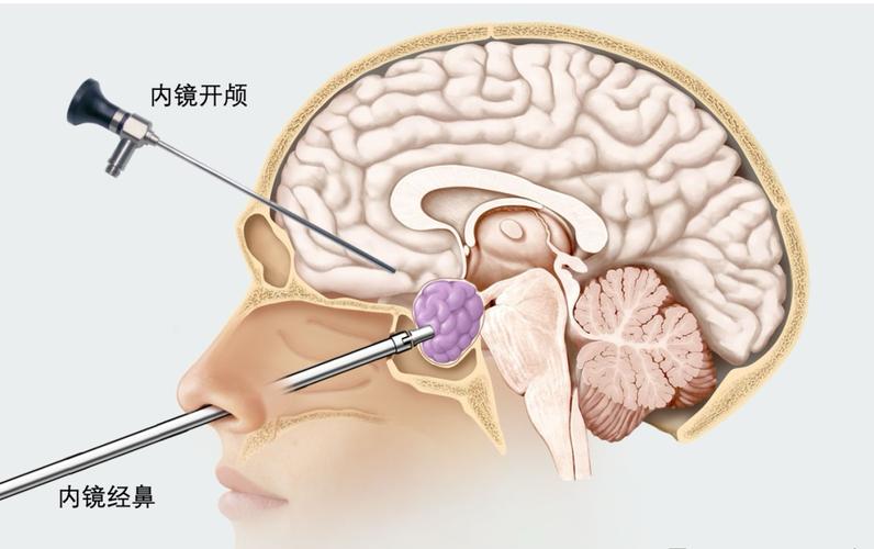  垂体瘤