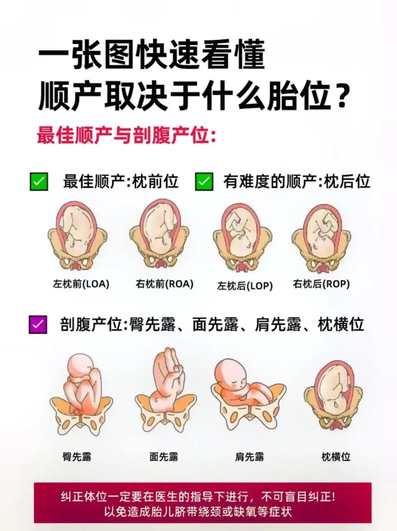 胎位不正