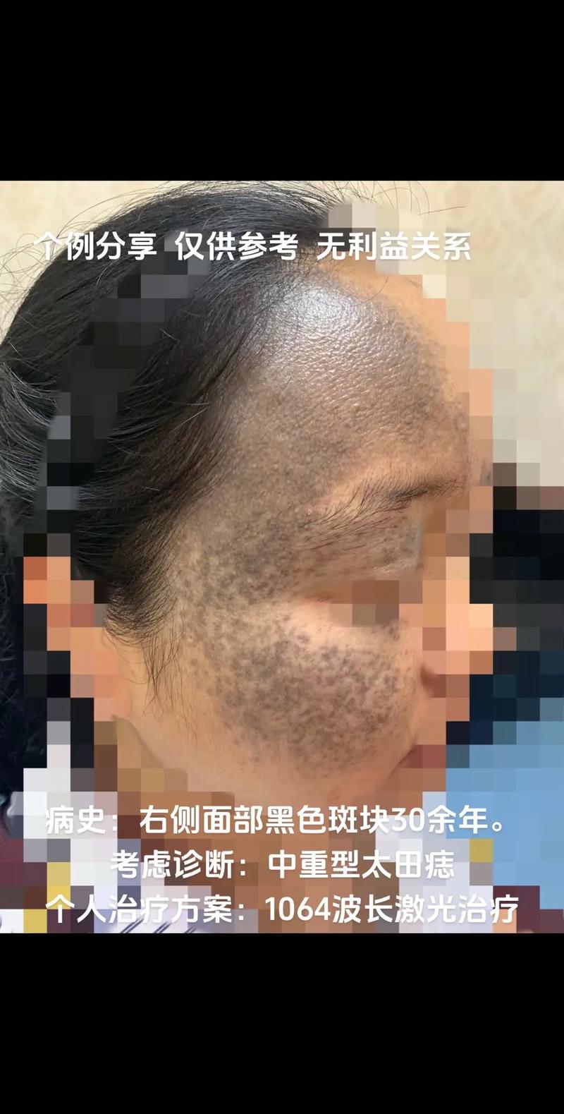 治疗个例