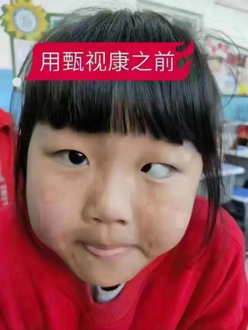 斜视