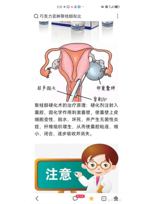  巧囊

<h1>提升巧囊试管成功率的有效方法与经验分享</h1>

<p>大家好，今天咱们聊聊一个特别贴近生活的话题——如何提升巧囊试管成功率。巧囊，也就是子宫内膜异位囊肿，这个病症可真是让不少家庭头疼。但别担心，咱们今天就来好好聊聊这个话题，分享一些实用的经验和方法。</p>

<h2>了解巧囊对试管的影响</h2>

<p>首先，咱们得明白巧囊对试管婴儿成功率的影响。巧囊是一种常见的妇科疾病，它可能会导致卵巢功能受损，影响卵子的质量。根据<a href