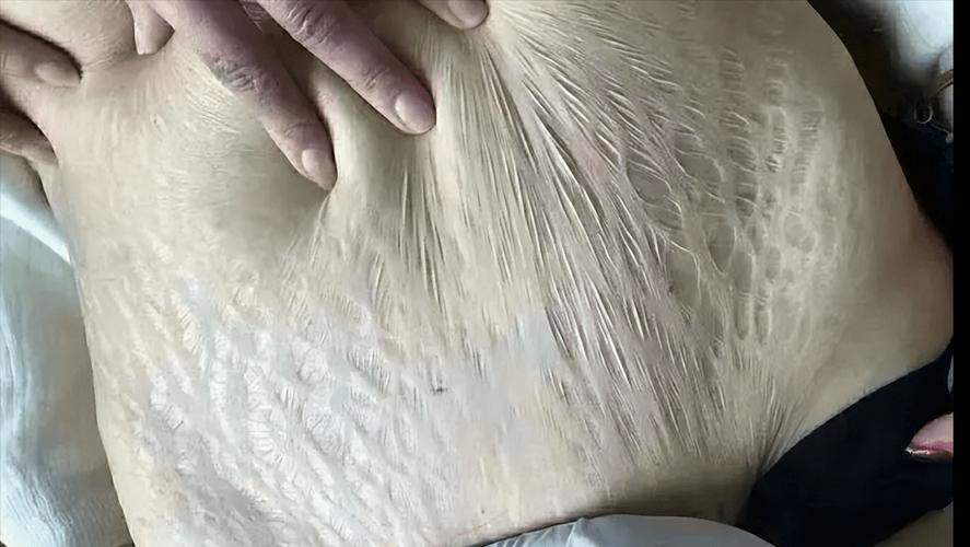 妊娠纹