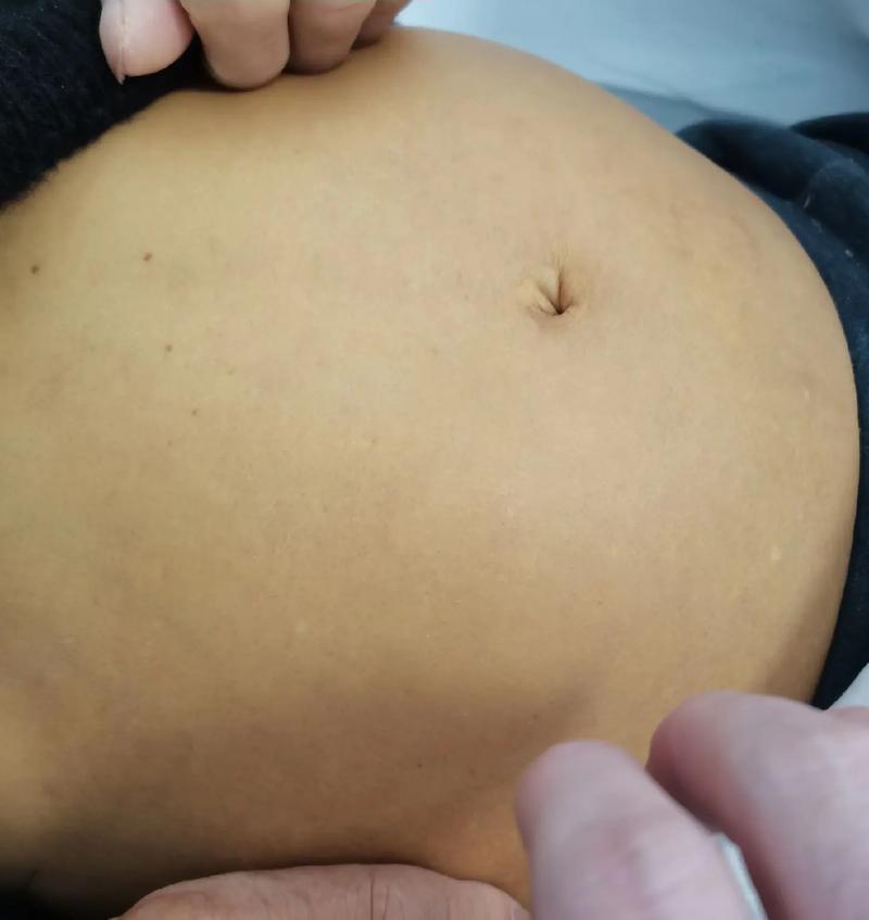 着床腹水