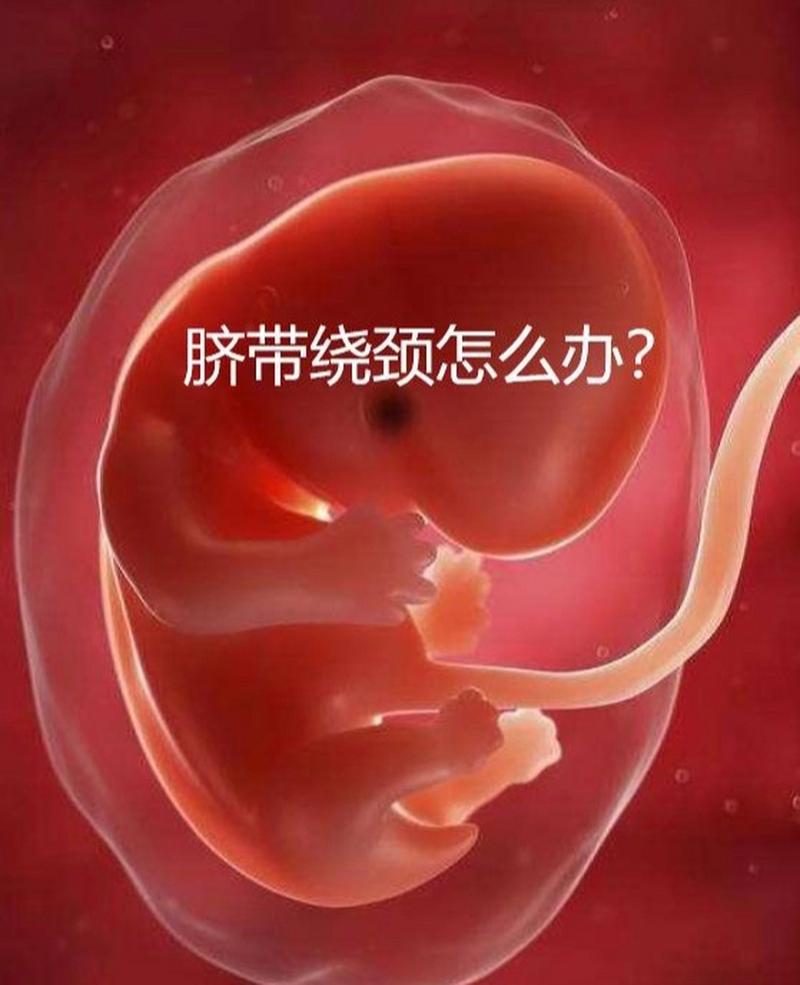 脐带绕颈
