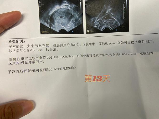 卵泡刺破