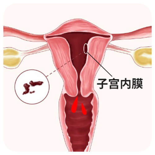  子宫内膜准备