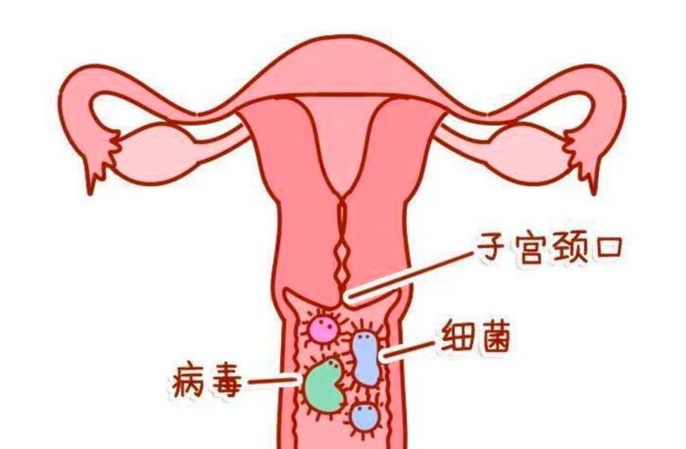 子宫炎症