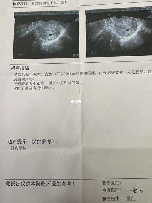 50 天胎心稍慢