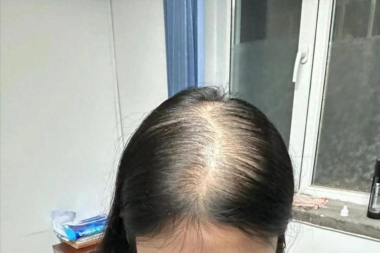 产后脱发