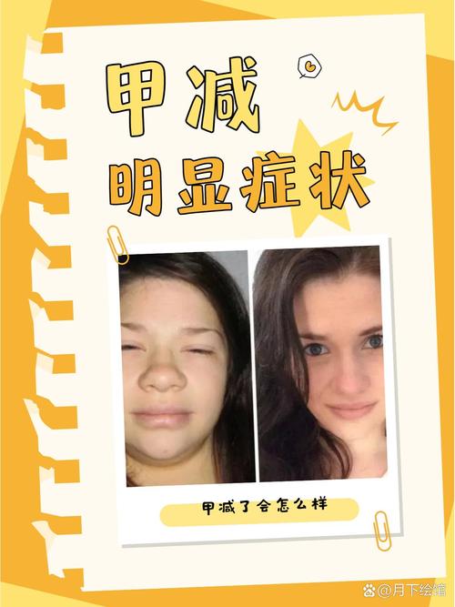 甲减、试管婴儿、生殖医疗