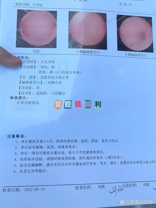  诊刮
