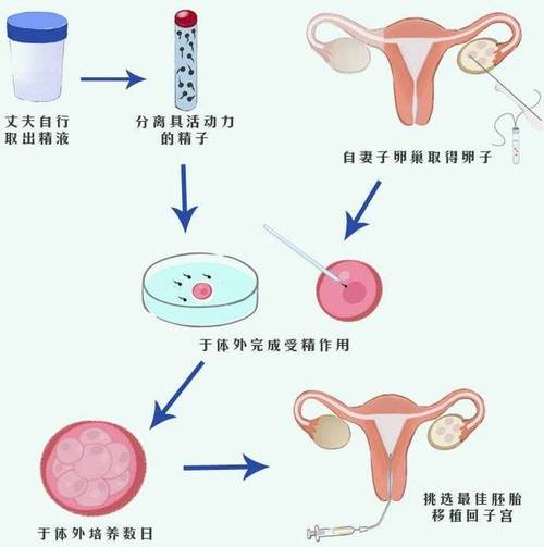 试管婴儿促排卵后步骤
