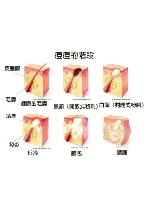 形成原因