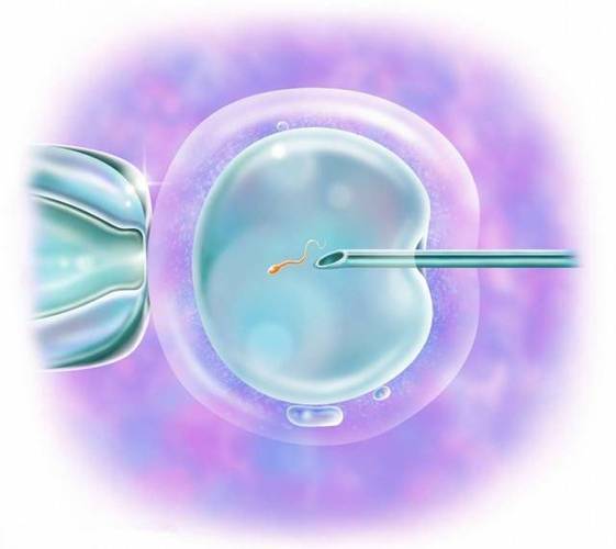 二代试管婴儿、配型成功、医疗技术、生殖希望
