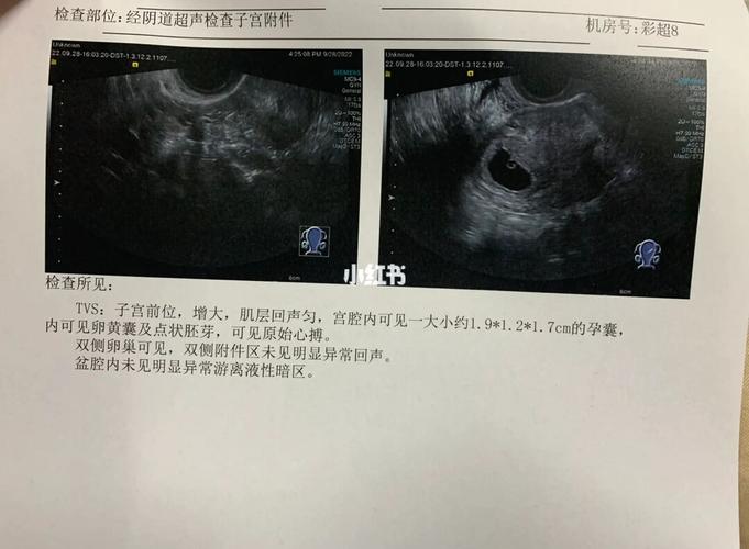 胎心小