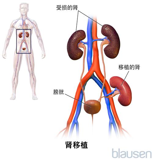 肾脏移植