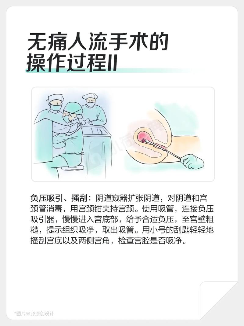 无痛流产