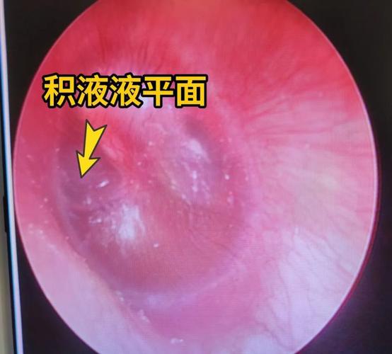  积液