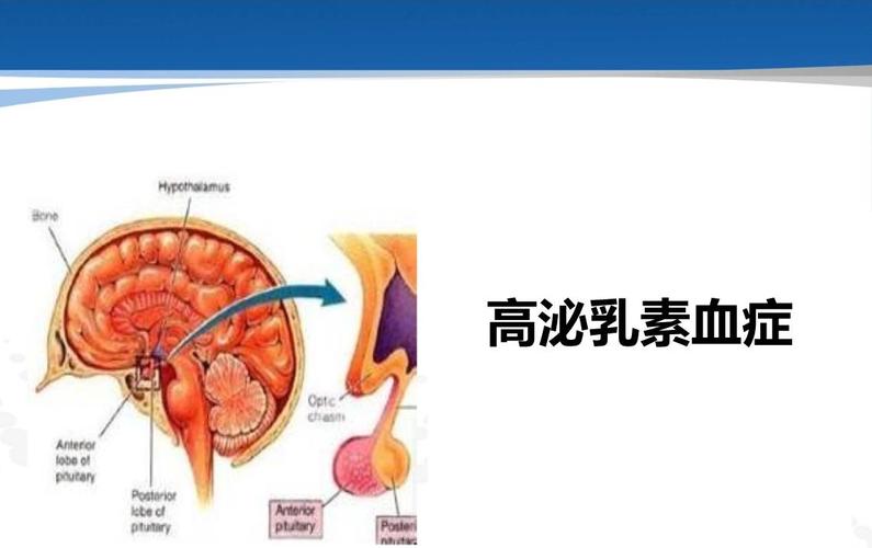 泌乳素血症