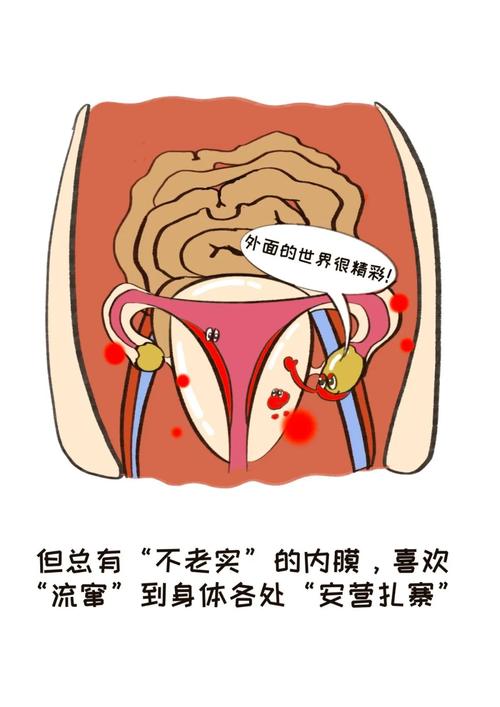 内异症