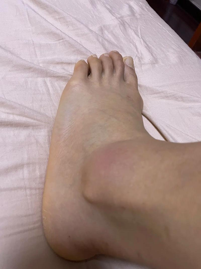 脚疼