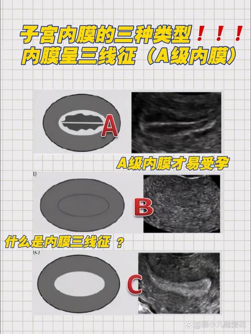 内膜判断