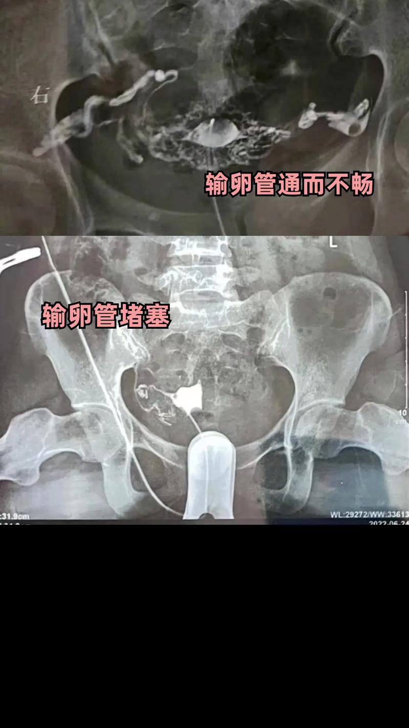输卵管不孕
