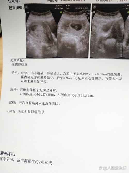 三个月胎心