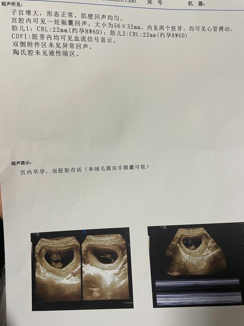 双胞胎确认