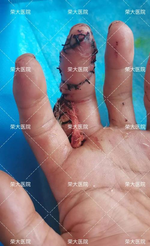 移植损伤