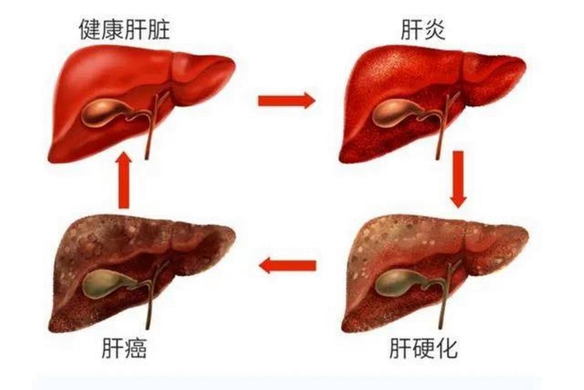  肝脏疾病