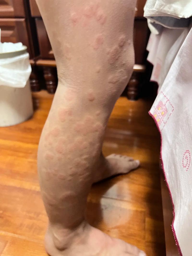 荨麻疹