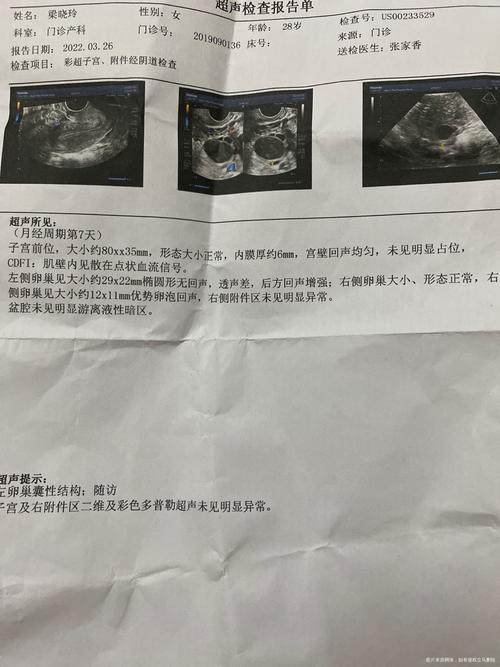 左侧卵巢无卵泡