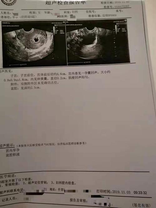 妇科B超