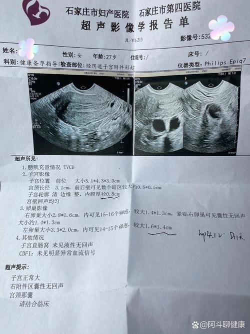 卵泡发育检查