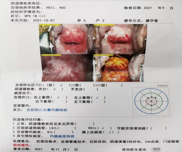 宫颈柱状上皮异位